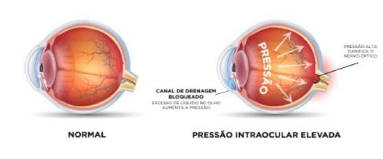 O que significa pressão intraocular elevada e por que controlá-la ...