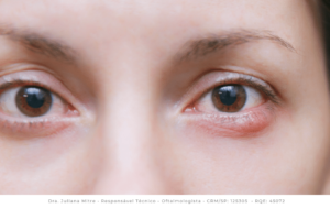 Terçol: entenda o que é e como identificar – Grupo HOSP