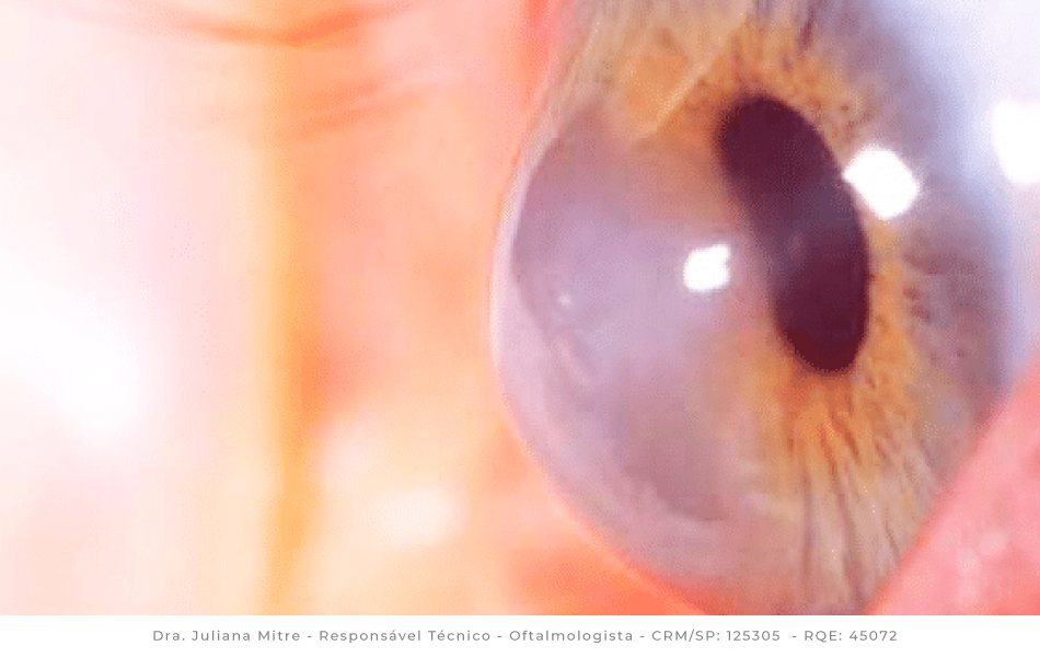 Ficar cego: temor relacionado ao ceratocone - Instituto de Moléstias  Oculares